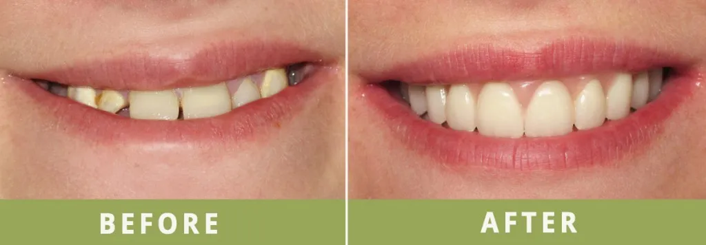Before and after pictures from i-Teeth